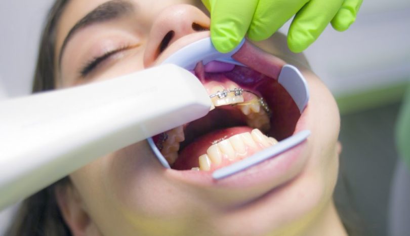Tandreglering med osynlig tandställning